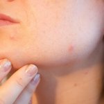 Gut health tips for clearing acne