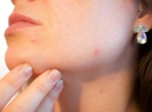 Gut health tips for clearing acne