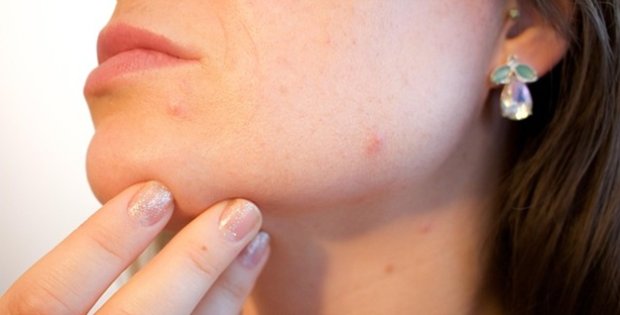 Gut health tips for clearing acne